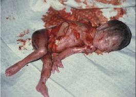 Abortado  niño indefenso, asesinatos