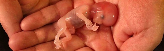 Noah murió en un aborto, pero su vida no será inútil gracias a la foto que su madre puso en Facebook